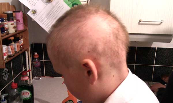 Причина выпадения волос на голове у ребенка 7 лет thumbnail