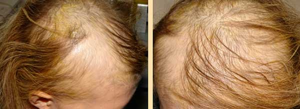 У ребенка лезут волосы при расчесывании 5 лет