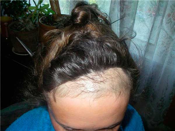 У ребенка лезут волосы при расчесывании 5 лет