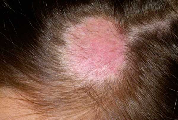 Причина выпадения волос на голове у ребенка 7 лет