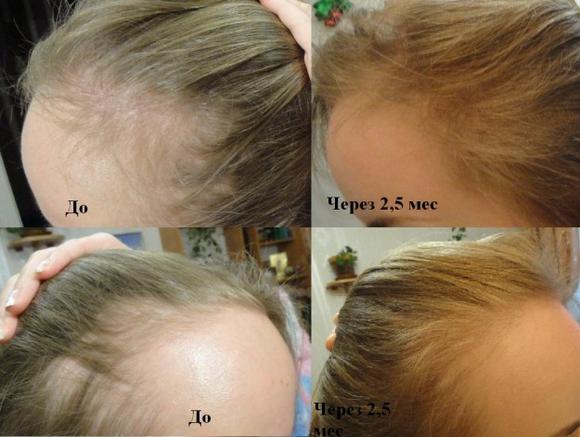 Спрей алерана от выпадения волос побочные эффекты