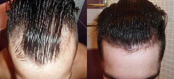 Алерана для мужчин спрей против выпадения волос