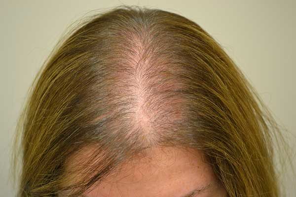 Алерана для мужчин спрей против выпадения волос