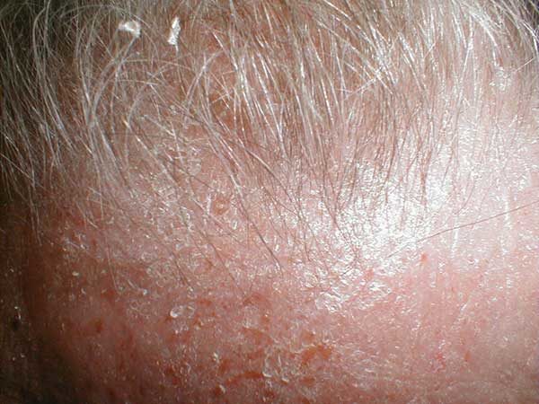 Спрей алерана от выпадения волос побочные эффекты