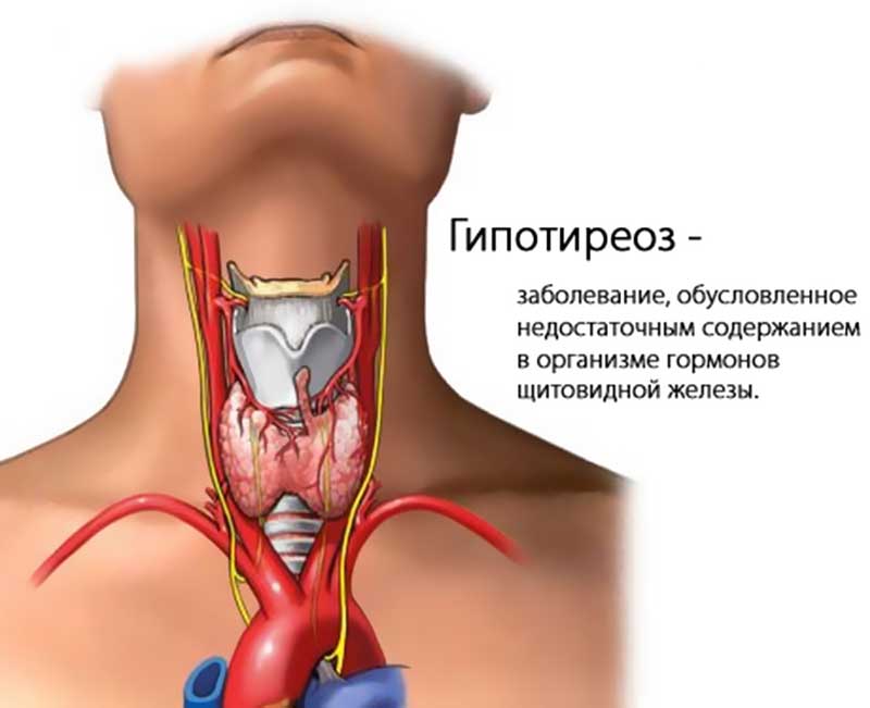 Hipotiroidismo engorda