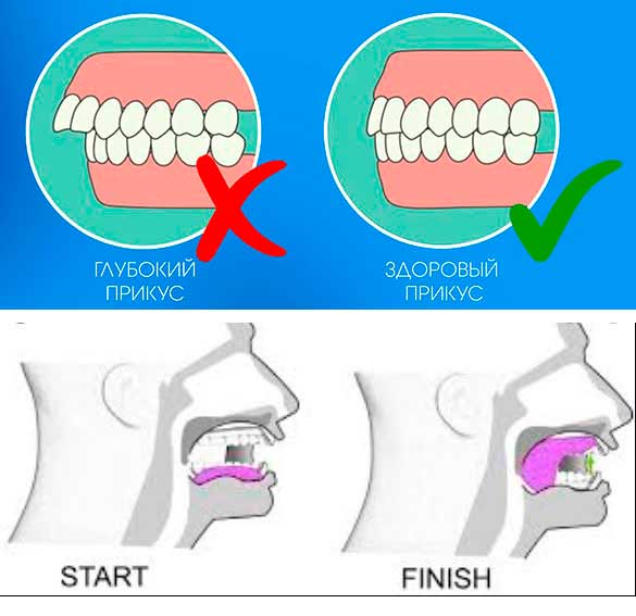 Зубы при закрытом рте. Правильное положение языка. Правильное положение языка во рту. Правильный прикус положение языка. Правильное положение зубов и языка.