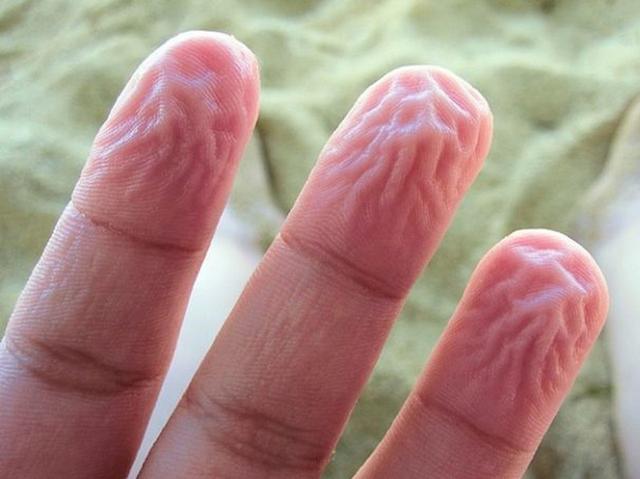 Причины мацерации кожи рук