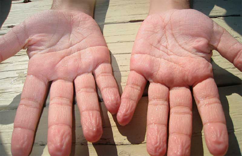 Причины мацерации кожи рук